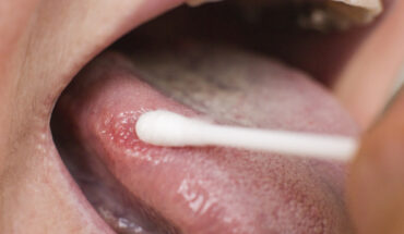 Common Oral Cancers
